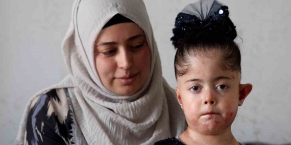 Elazığ’da Kelebek Hastalığı ile Mücadele Eden Fatma İçin Yardım Bekleniyor Elazığ’da Kelebek Hastalığı ile Mücadele Eden Fatma İçin Yardım Bekleniyor