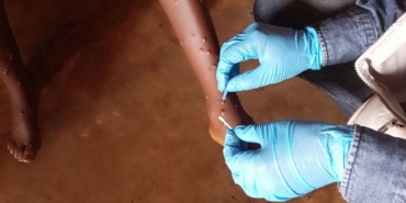 Maymun Çiçeği: Nedir, Nasıl Bulaşır ve Önlemler Nelerdir?