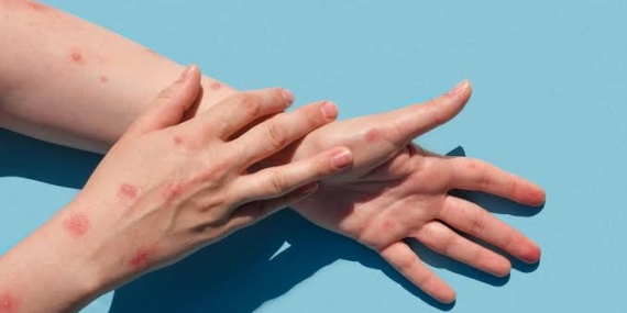 "Ankara'da maymun çiçeği var" iddiaları yalanlandı “Ankara’da maymun çiçeği var” iddiaları yalanlandı