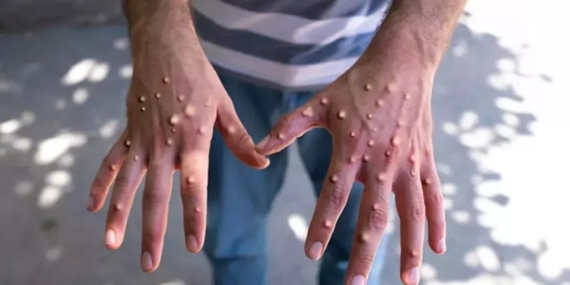 Hızla yayılıyor: İşte 11 soruda maymun çiçeğiyle ilgili merak edilenler Hızla yayılıyor: İşte 11 soruda maymun çiçeğiyle ilgili merak edilenler