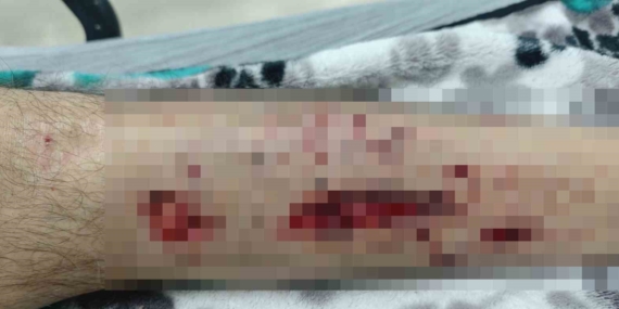 Diyarbakır'da Sokak Köpeklerinin Saldırısına Uğrayan Alzheimer Hastası Adam Diyarbakır’da Sokak Köpeklerinin Saldırısına Uğrayan Alzheimer Hastası Adam