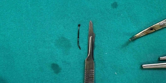 Güroymak'ta 5 Yaşındaki Çocuğun Yuttuğu Toplu İğne Başarıyla Çıkarıldı Güroymak’ta 5 Yaşındaki Çocuğun Yuttuğu Toplu İğne Başarıyla Çıkarıldı