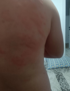 elazigda-bocek-isirigi-nedeniyle-hastaneye-basvuranlar-RJ5vA89k.jpg