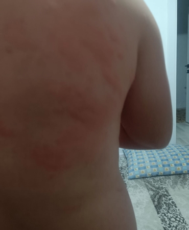 elazigda-bocek-isirigi-nedeniyle-hastaneye-basvuranlar-RJ5vA89k.jpg
