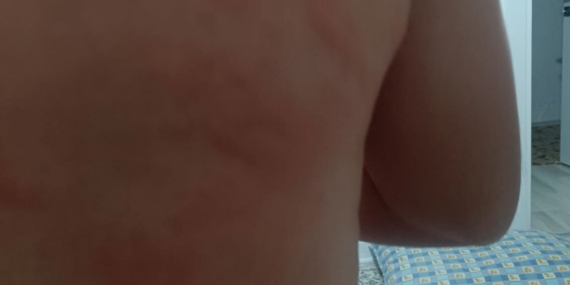 Elazığ'da Böcek Isırığı Nedeniyle Hastaneye Başvuranlar Elazığ’da Böcek Isırığı Nedeniyle Hastaneye Başvuranlar
