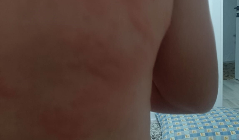 elazigda-bocek-isirigi-nedeniyle-hastaneye-basvuranlar-RJ5vA89k.jpg