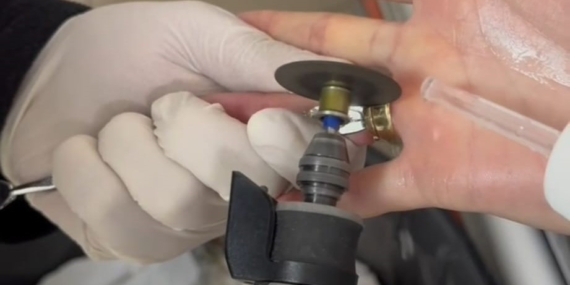 Batman’da Parmağa Sıkışan İki Yüzük Spiral Makineyle Kurtarıldı